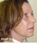 postop postop